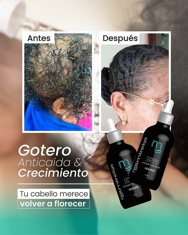 Comparaison des résultats avant et après l'utilisation du compte-gouttes anti-chute et croissance natmirelys. Sur la première photo, les cheveux paraissent fins et clairsemés, tandis que la deuxième image montre une croissance régulière, vigoureuse et saine. Ci-dessous, deux flacons noirs du produit avec compte-gouttes.